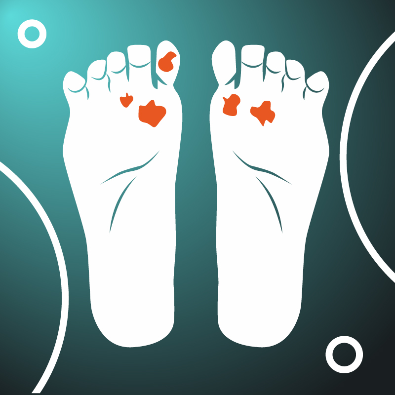 Diabetic Foot