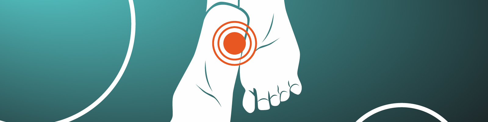 Plantar Fasciitis