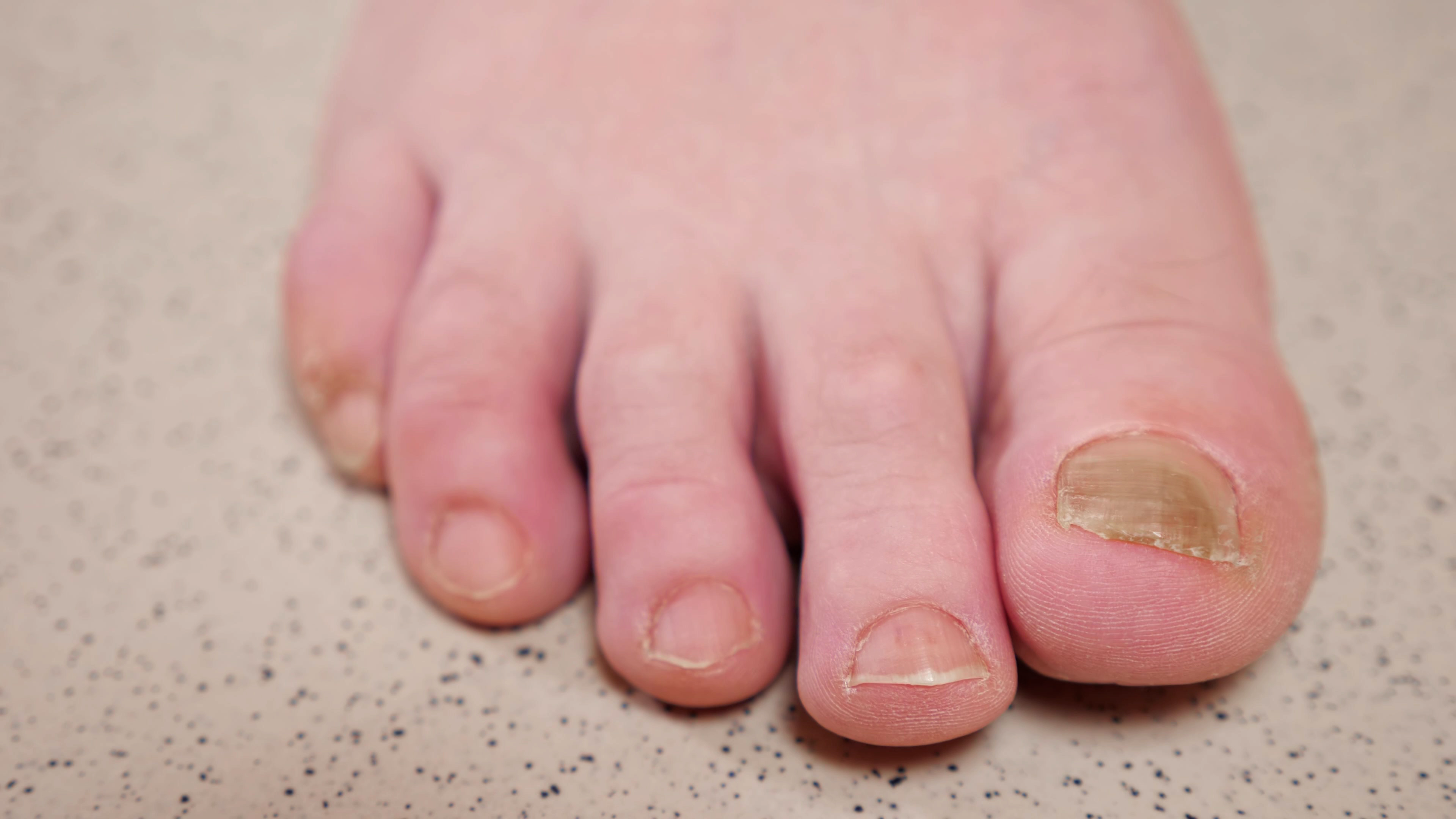 Close up of toes with Toenail Fungus