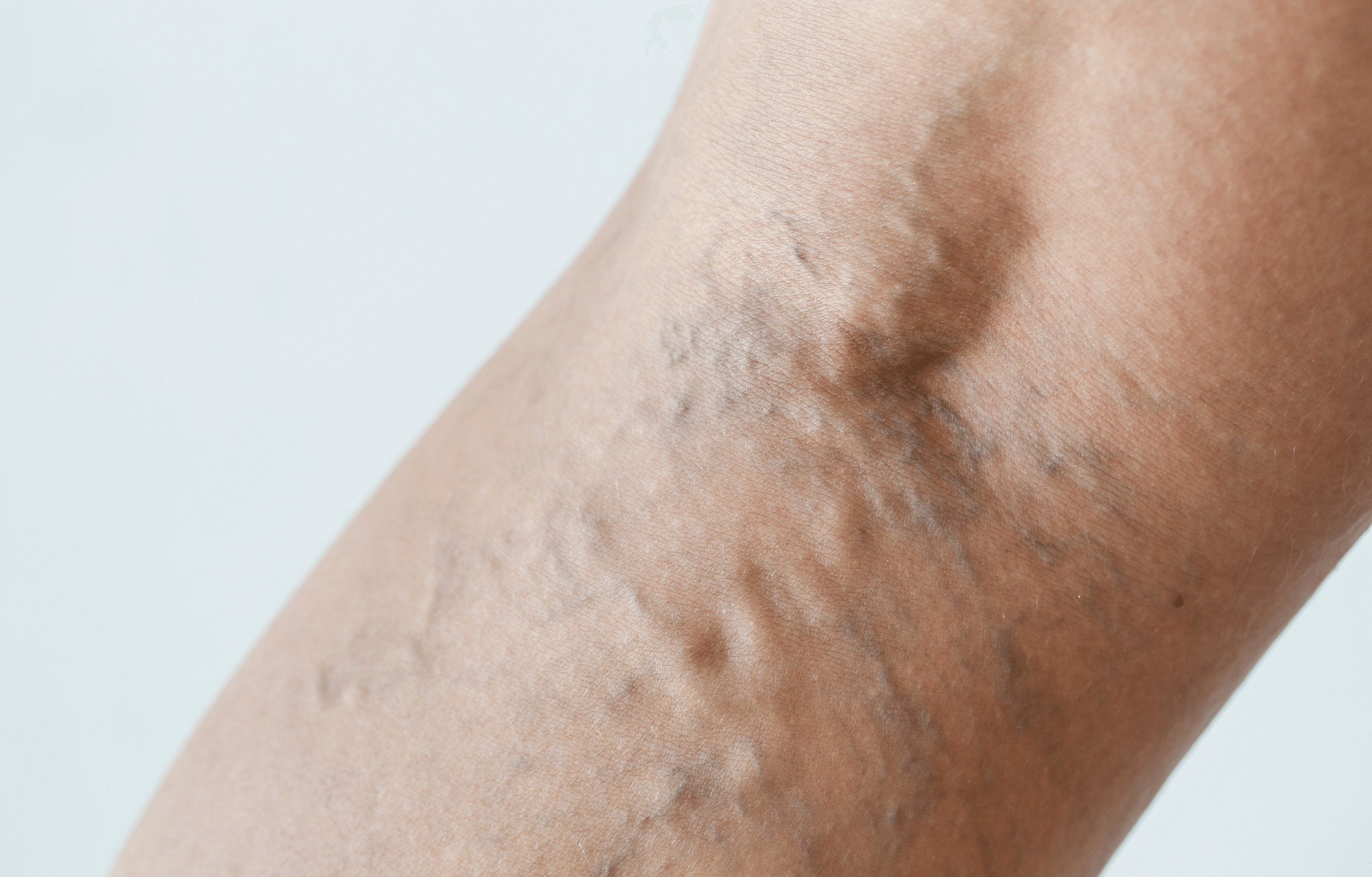 Close up varicose veins